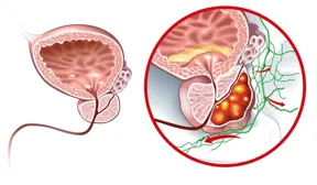 Ilustração médica de câncer de próstata avançado com metástase linfonodal