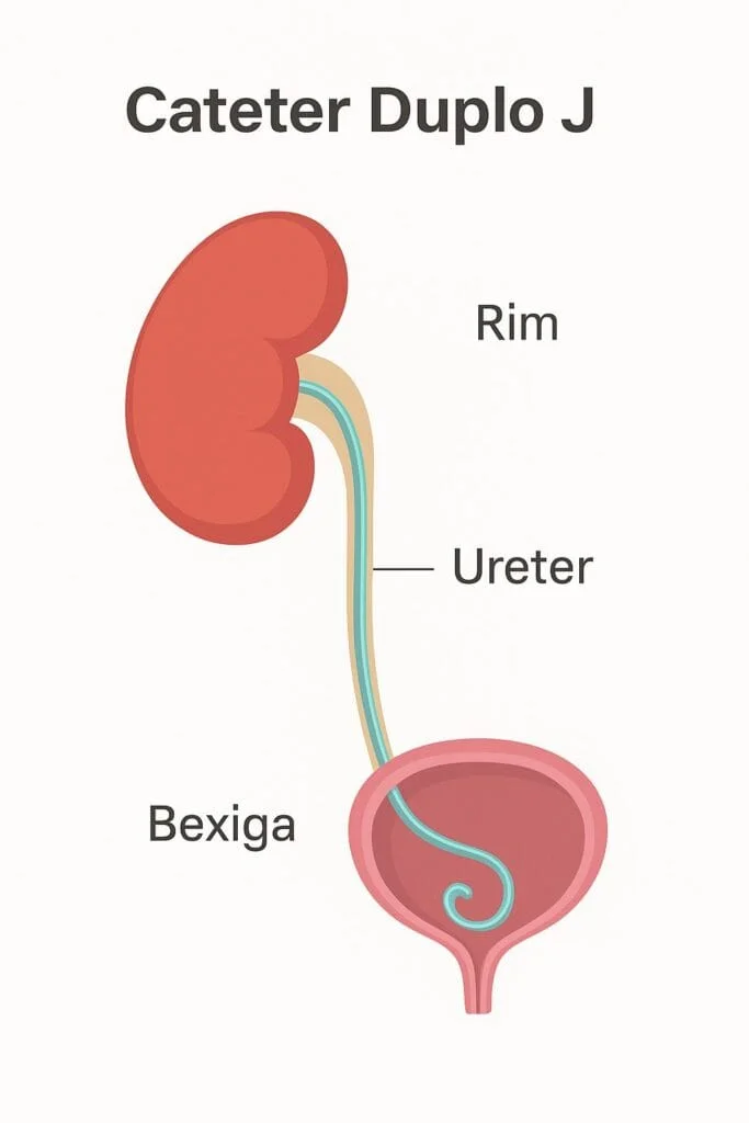 Ilustração anatômica do cateter duplo J entre rim e bexiga