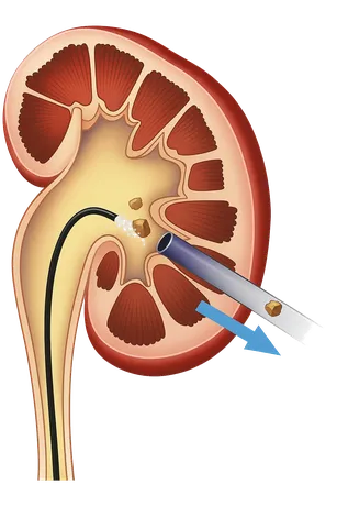 Ilustração da técnica ECIRS com acesso combinado ao rim para remoção de cálculo