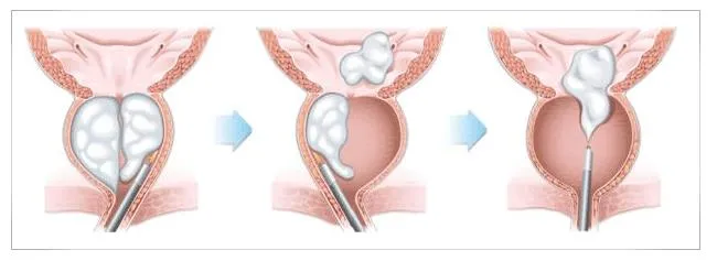 Ilustração frontal do procedimento HoLEP mostrando a enucleação do adenoma prostático com instrumento cirúrgico a laser.