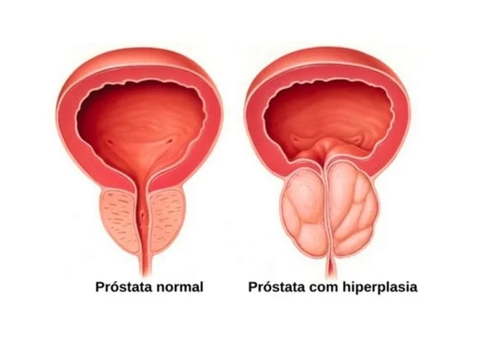 Imagem ilustrativa de próstata aumentada por HPB