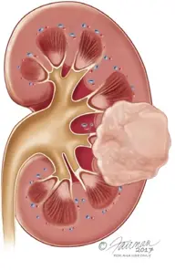 Ilustração médica de rim com tumor renal