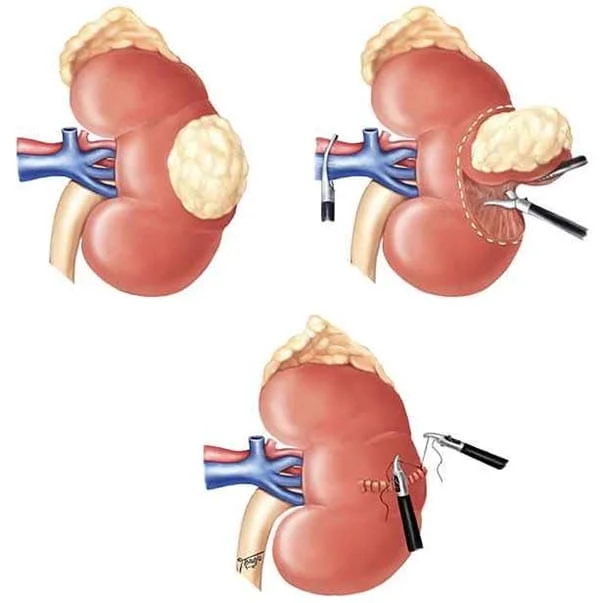 Ilustração médica de cirurgia para tumor renal com preservação parcial do rim