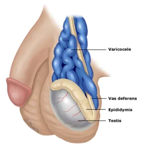 Ilustração médica demonstrando veias dilatadas (varicocele) no testículo esquerdo