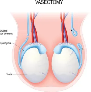 Ilustração médica demonstrando o canal deferente seccionado na vasectomia