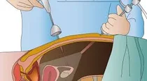 Ilustração da cirurgia videolaparoscópica em urologia