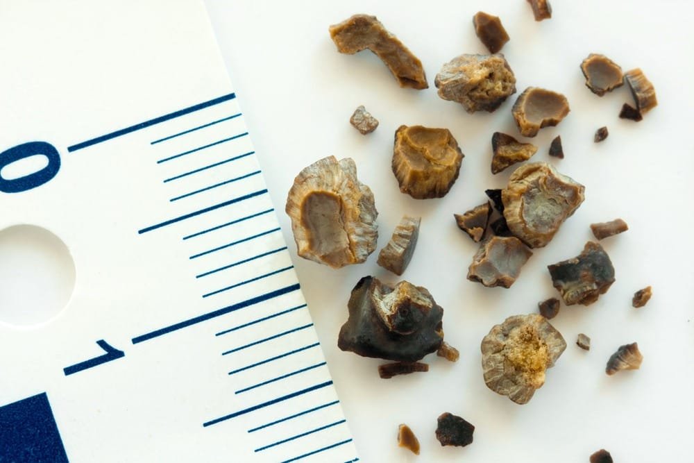 Ureterorrenolitotripsia a laser para cálculo renal – Dr. Pedro Bastos Urologista em Juiz de Fora