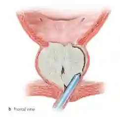 Ilustração frontal do procedimento HoLEP mostrando a enucleação do adenoma prostático com instrumento cirúrgico a laser.