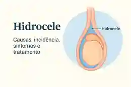 Ilustração médica da hidrocele mostrando acúmulo de líquido ao redor do testículo com legenda explicativa